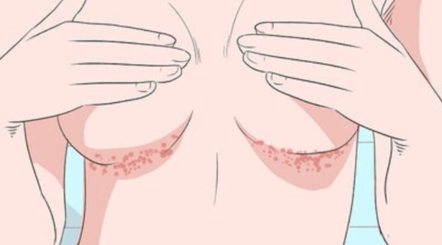 zona inframamaria irritada almidona secante